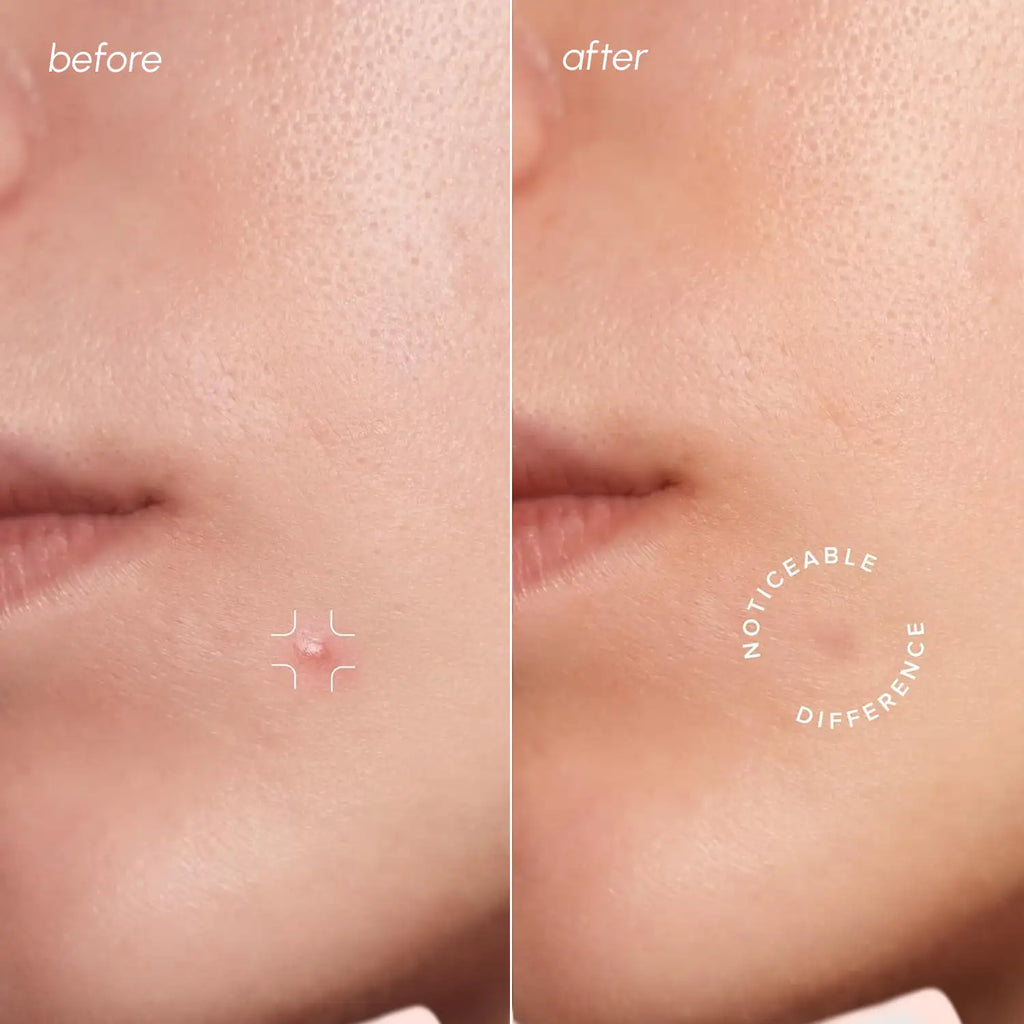 Clear Calm Invisible Acne Patches