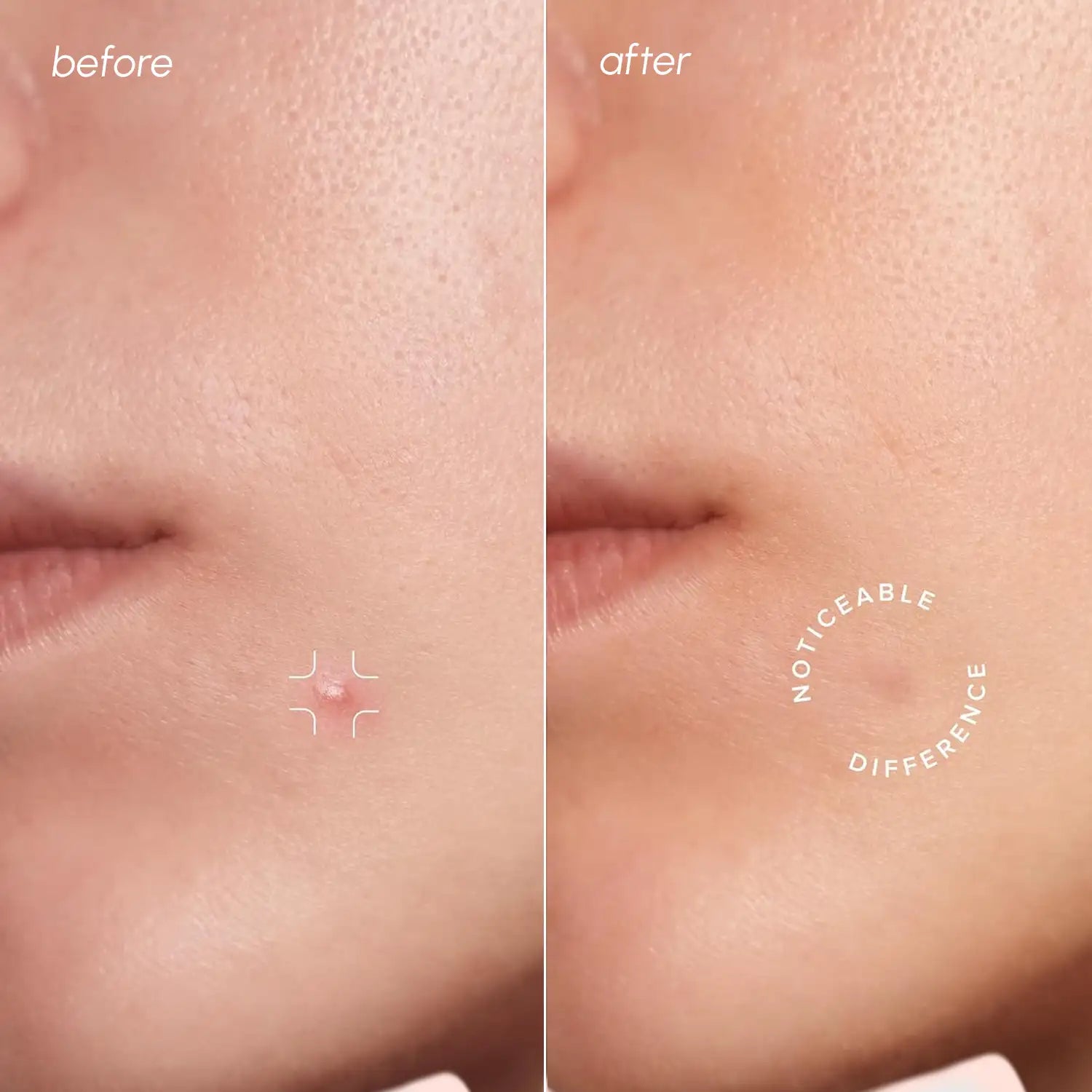 Clear Calm Invisible Acne Patches