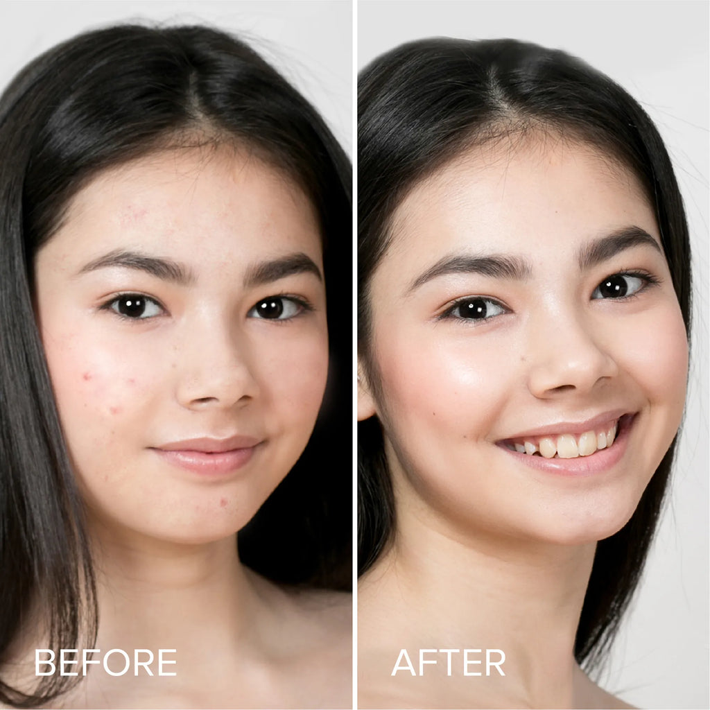 Clear Calm Acne Patches