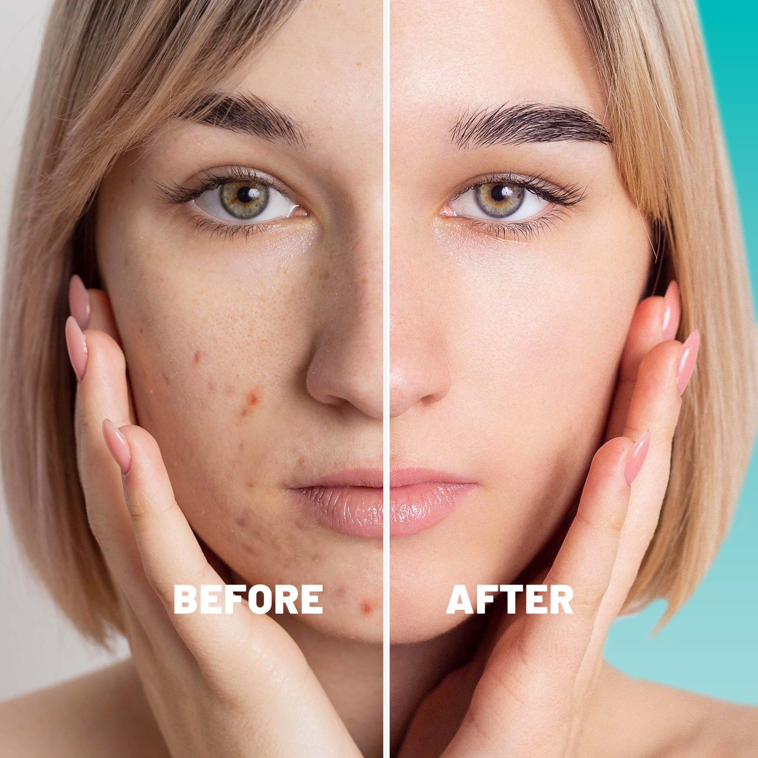 Microdart Patches Targeted Blemish & Skin Support with Hyaluronic Acid, Salicylic Acid & Niacinamide, 9 Patches