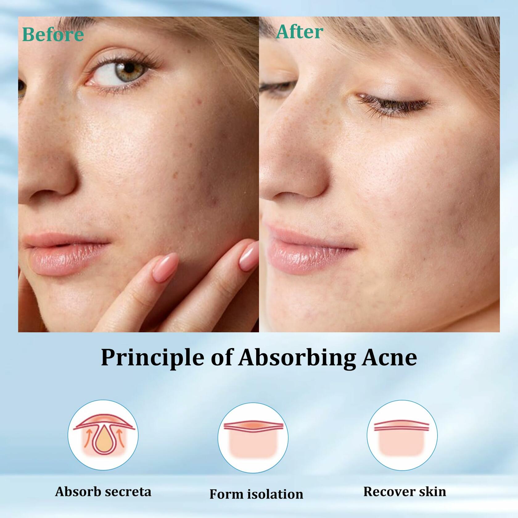 SHIVRISE Tea Tree Oil Hydrocolloid Pimple Patches – 36 Count